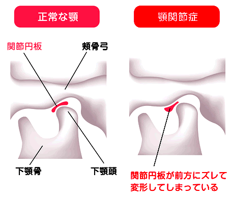 顎関節の構造、関節円板のズレ