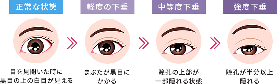 正常な状態:目を見開いたときに黒目の上の白目が見える/軽度下垂:まぶたが黒目にかかる/中等度下垂:瞳孔の上部が一部隠れる/強度下垂:瞳孔が半分以上隠れる