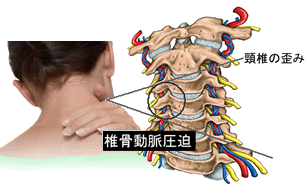 椎骨動脈の圧迫