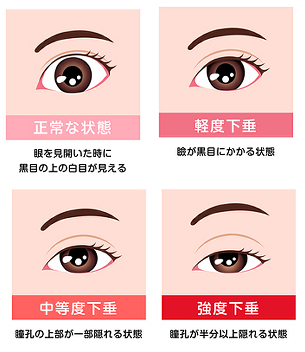 眼瞼下垂の程度分類