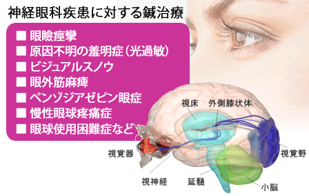眼瞼痙攣、ビジュアルスノウ、眼球使用困難症など神経眼科疾患に対する鍼治療のご案内