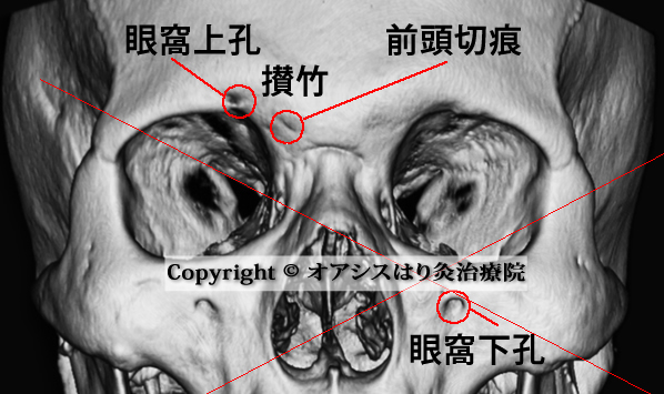 成人男性の眼窩CTスキャン画像 前頭切痕お眼窩上孔の画像