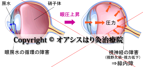房水循環と眼圧、緑内障のイラスト