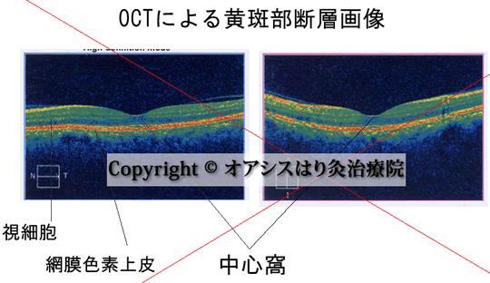 OCTによる黄斑部断層画像イラスト